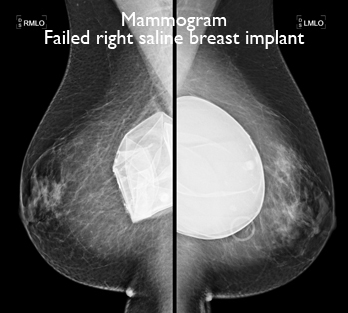 Breast Augmentation Saline