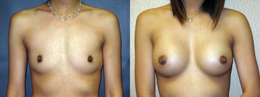 dr dembny-breast_augmentation-silicone-Bcup