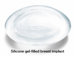 Silicone gel breast implant