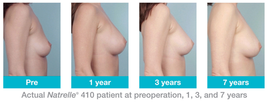 Consistent breast shape with Natrelle 410 years 1 - 7