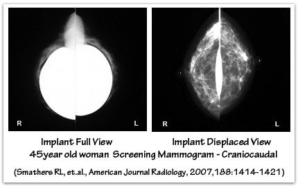 Craniocaudal mammogram full vs eklund displaced views