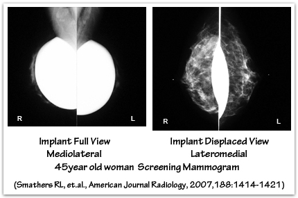 Mediolateral mammogram full vs eklund displaced views