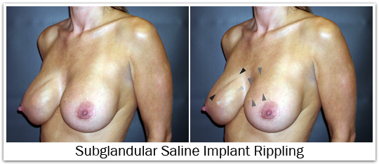 Subglandular saline implant rippling