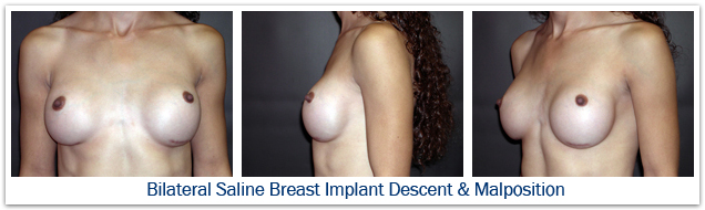 Bilateral saline breast implant malposition