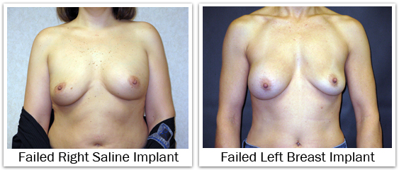 Failed saline breast implants