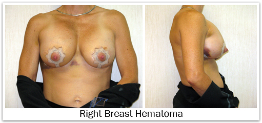 Right breast hematoma