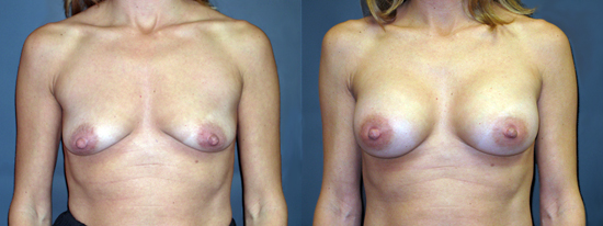 Dr Dembny silicone breast augmentation 182