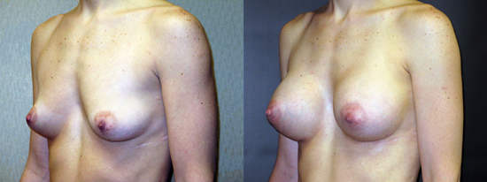 Dr Dembny silicone breast augmentation 185