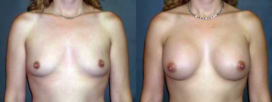 Dr Dembny silicone breast augmentation 79