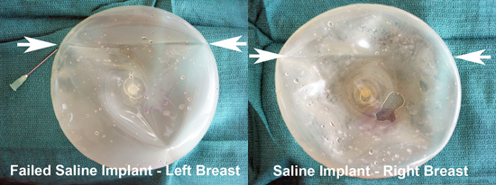saline-breast-imlants-with-creases-in-the-shells