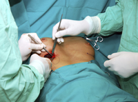 breast-augmentation-surgery-in-the-operating-room