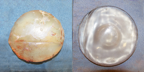 275cc-Silicone-Gel-Breast-Implant-and-Capsular-Contracture