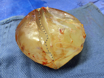Breast-Implant-Shell-Folding-Inside-Capsular-Contracture