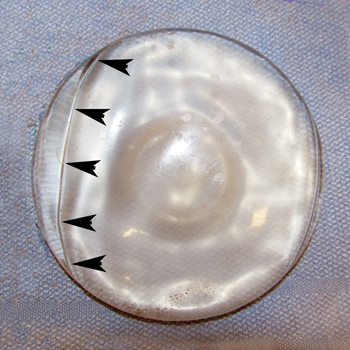 Silicone-Gel-Breast-Implant-with-Crease-in-Shell