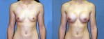 Patient-117-AP-Natrelle-Silicone-Gel-Round-High-Profile-Breast-Augmentation-Milwaukee-WI