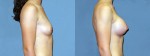 Patient-117-RLat-Natrelle-Silicone-Gel-Round-High-Profile-Breast-Augmentation-Milwaukee-WI