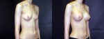 Patient-118-ROblq-Silicone-Gel-Breast-Augmentation-Milwaukee-WI