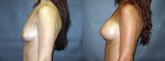 Patient-159-LLat-Silicone-Gel-Breast-Augmentation-Milwaukee-WI