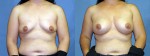 Patient-668-AP-Natrelle-Silicone-Gel-Round-Moderate-Profile-Breast-Augmentation-Milwaukee-WI