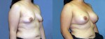 Patient-668-ROblq-Natrelle-Silicone-Gel-Round-Moderate-Profile-Breast-Augmentation-Milwaukee-WI