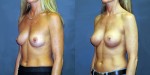 Patient-700-LOblq-Natrelle-410-Breast-Augmentation-Milwaukee-WI