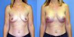 Patient-771-AP-Natrelle-FM410-Breast-Augmentation-Cedarburg-WI
