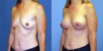 Patient-771-LOblq-Natrelle-FM410-Breast-Augmentation-Cedarburg-WI
