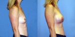 Patient-771-RLat-Natrelle-FM410-Breast-Augmentation-Cedarburg-WI