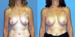 Patient-777-AP-Natrelle-Silicone-Round-Moderate-Profile-Breast-Augmentation-Milwaukee-WI