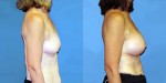 Patient-777-RLat-Natrelle-Silicone-Round-Moderate-Profile-Breast-Augmentation-Milwaukee-WI