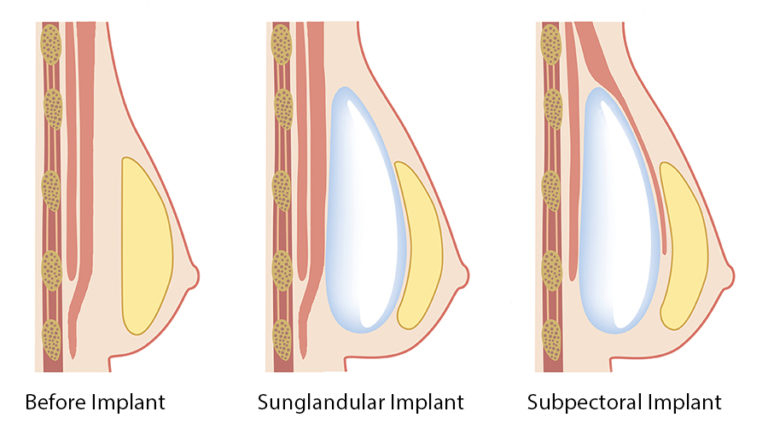 breast-implant-pocket-location-subglandular-submuscular