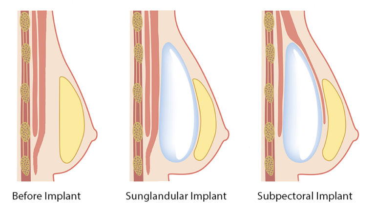 Breast Implant Pocket Location, Milwaukee, Wisconsin